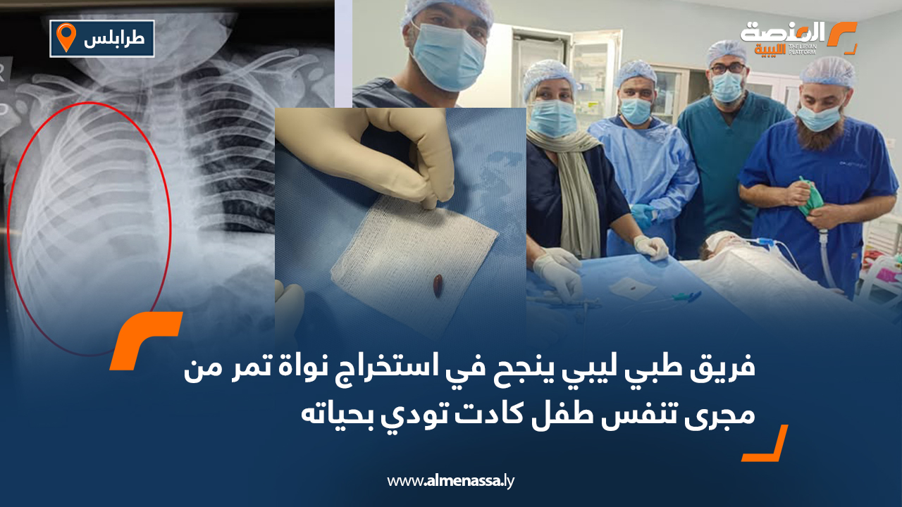 استخراج نواة بلح من طفل تسببت في اختناقه