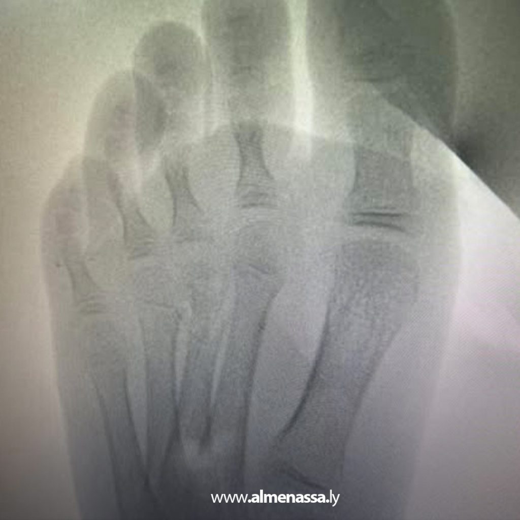 extra 48 جراح ليبي يروي تفاصيل إخراج إبرة خياطة من داخل تجويف عظم طفلة