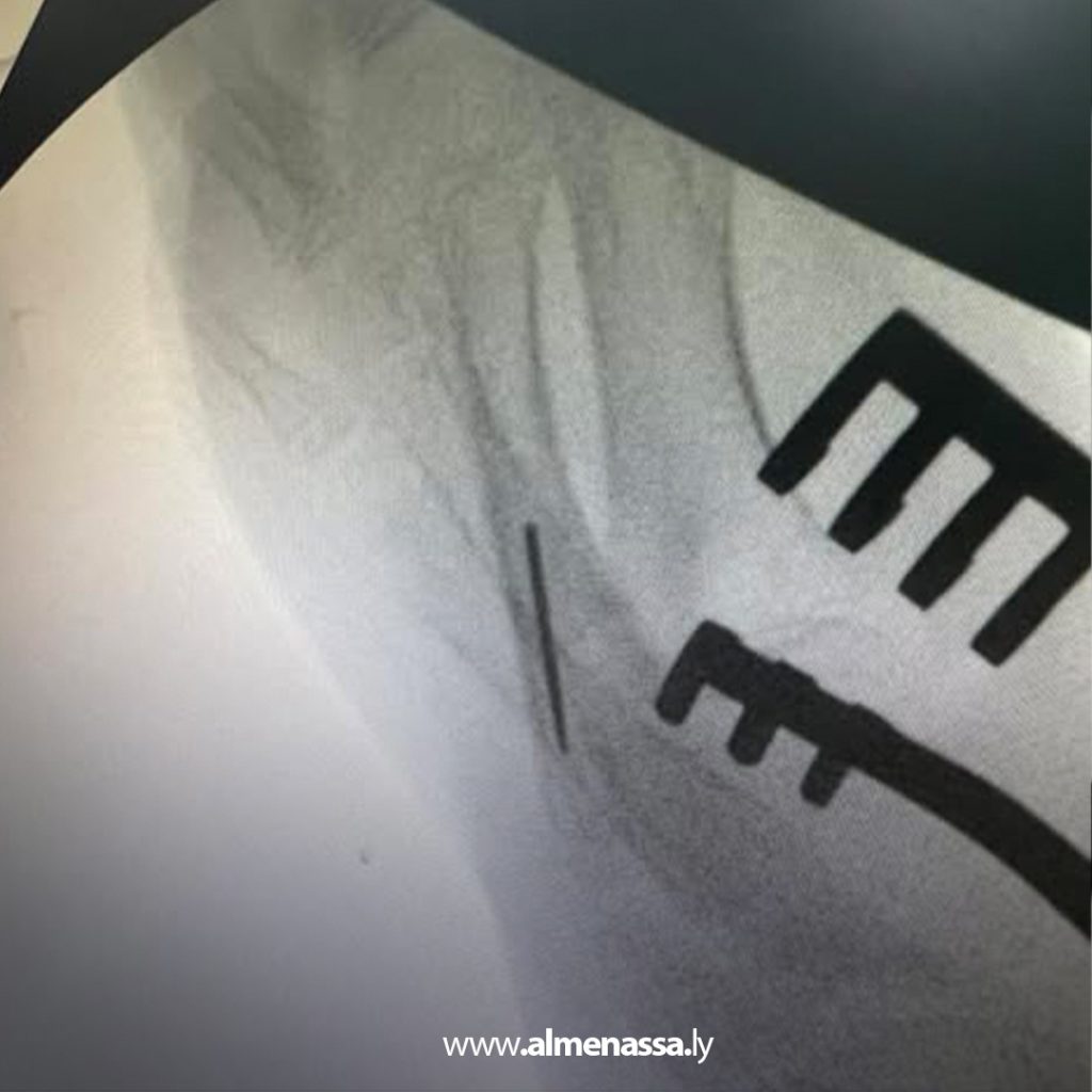 extra1 42 جراح ليبي يروي تفاصيل إخراج إبرة خياطة من داخل تجويف عظم طفلة