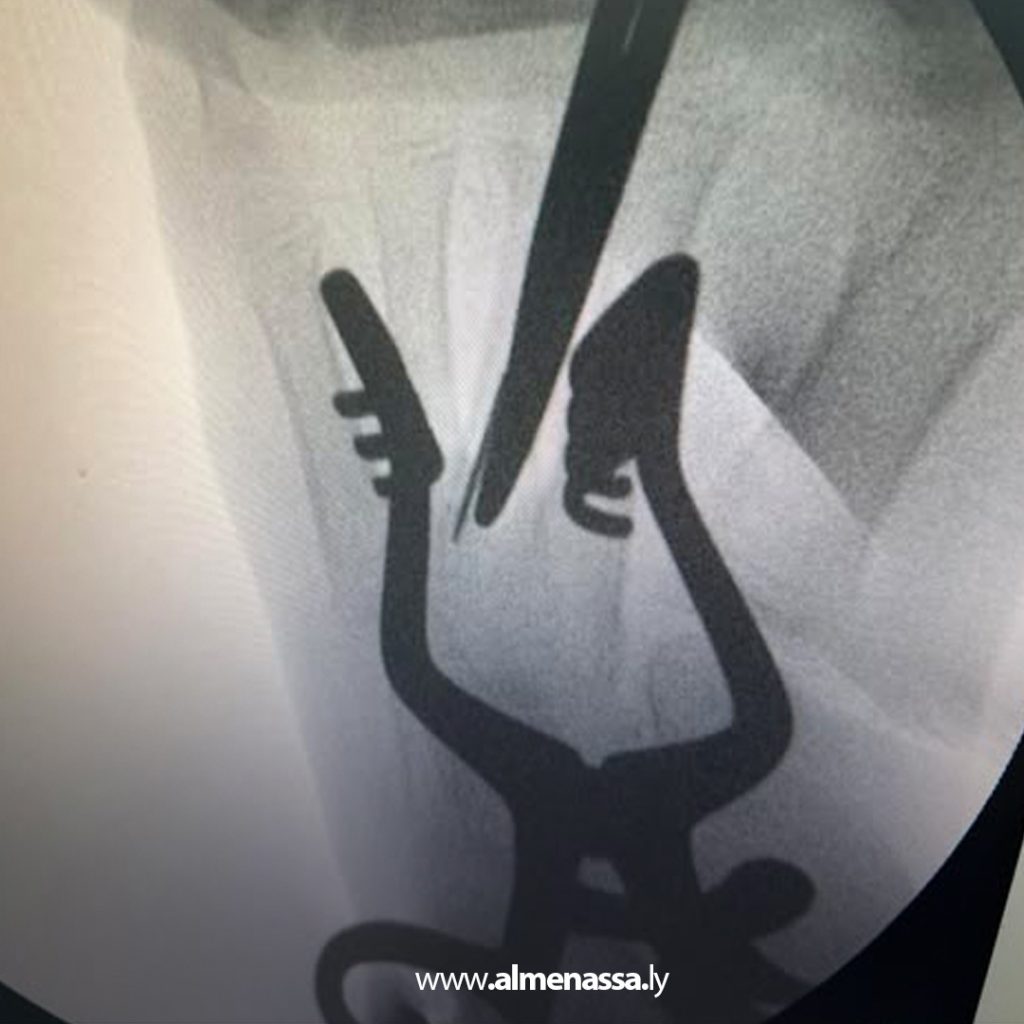 extra11 23 جراح ليبي يروي تفاصيل إخراج إبرة خياطة من داخل تجويف عظم طفلة