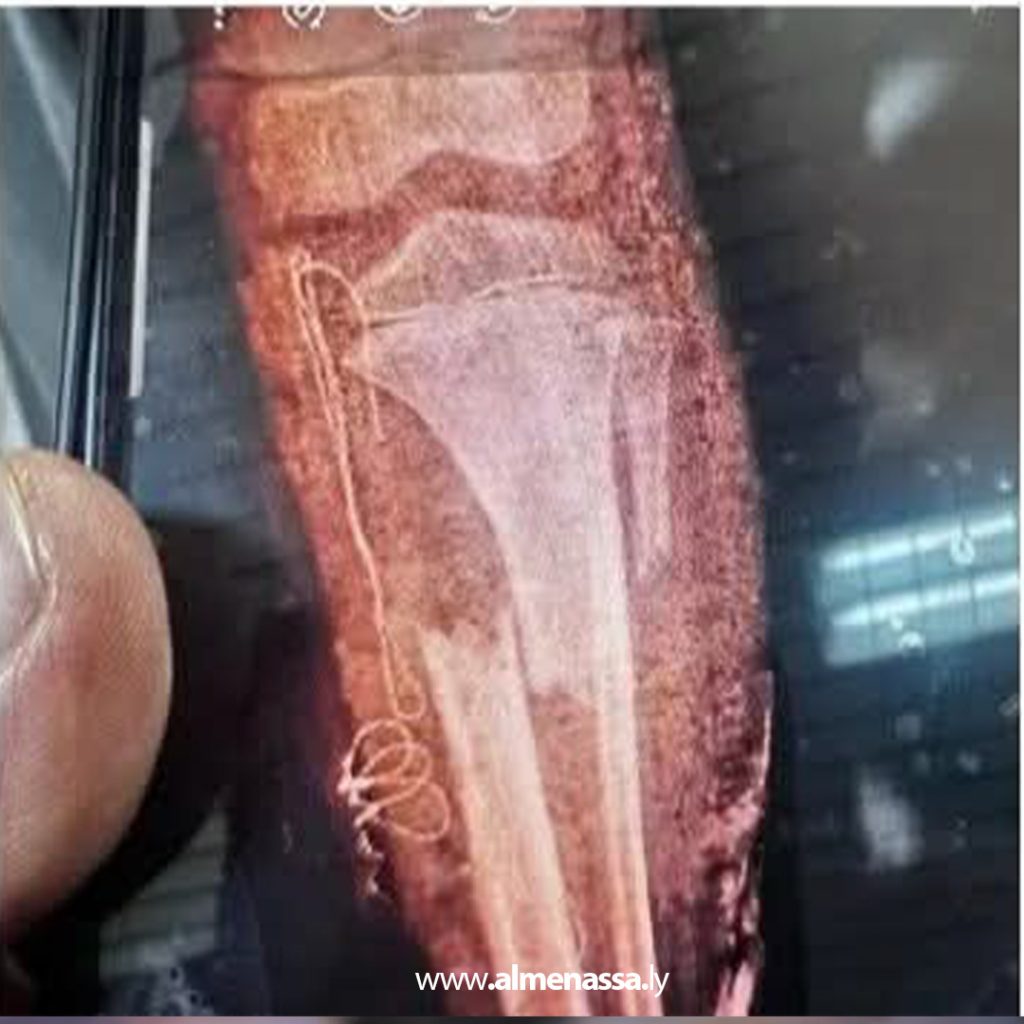 04 23 مركز طبرق الطبي يستقبل أربعة أطفال مصابين جراء سقوط سقف مسجد بمنطقة القعرة