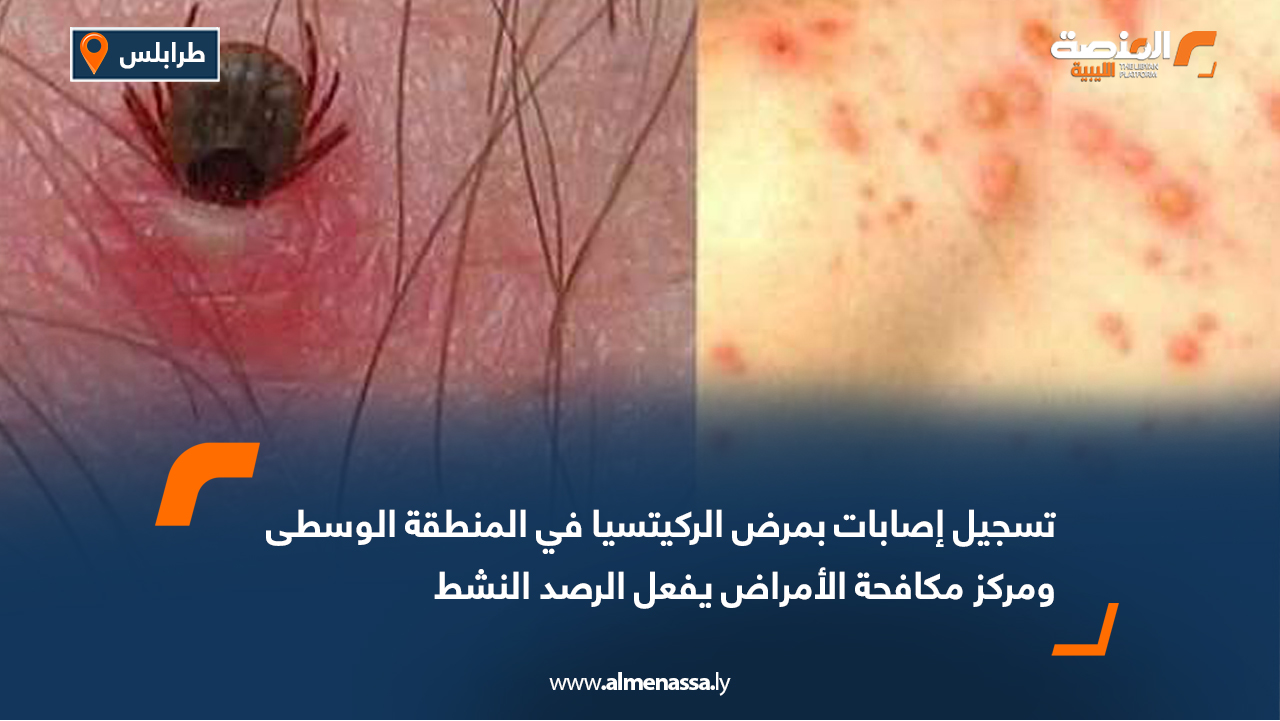 تسجيل إصابات بمرض الركيتسيا في المنطقة الوسطى ومركز مكافحة الأمراض يفعل الرصد النشط