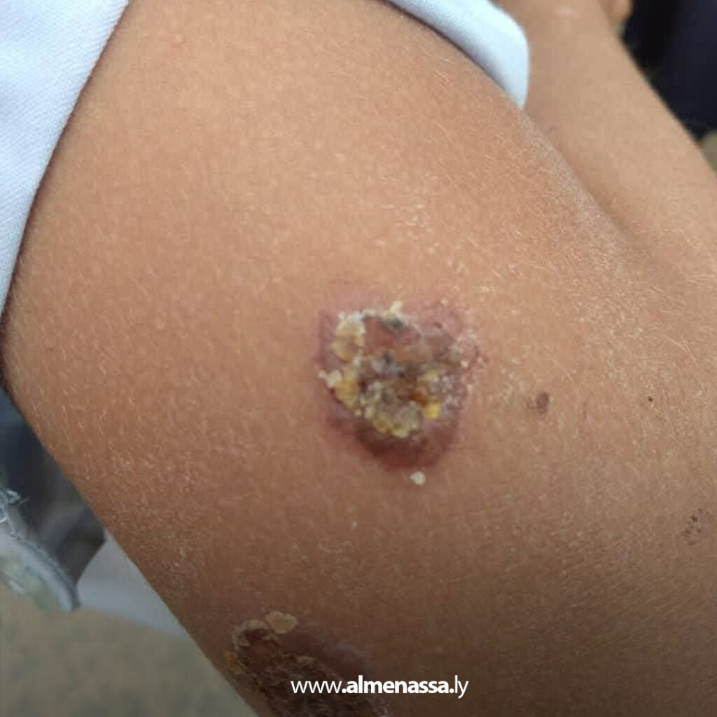 Extra 46 ترهونة تعلن توفير علاج اللشمانيا لطلاب المدارس المصابين