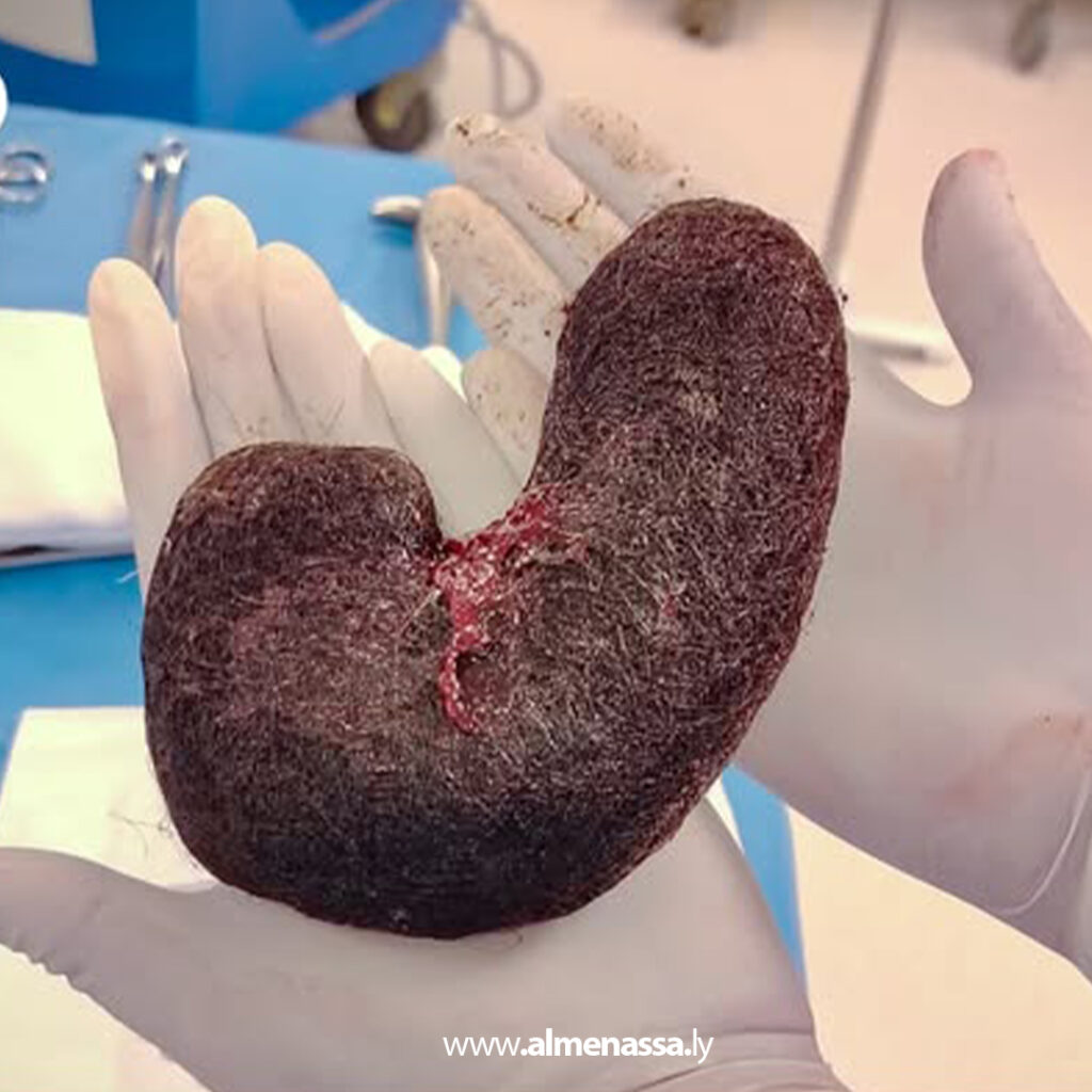 Extra 17 نجاح عملية نادرة لإزالة كتل شعر من معدة مريضة مصابة بمتلازمة "روبنزل" في مستشفى المقريف