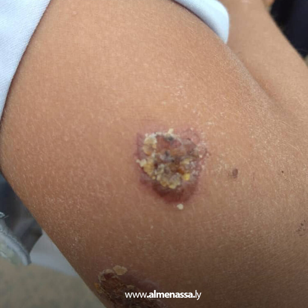 Extra 64.jpg1 64 تعليم ترهونة: توفير العلاج لطلاب مصابين بمرض اللشمانيا وتوجيهات لأولياء الأمور