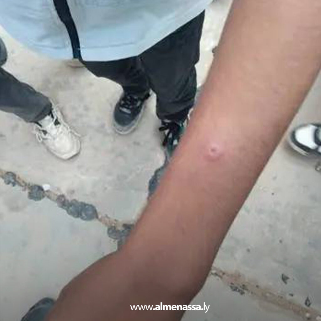 Extra 93 تعليم ترهونة: توفير العلاج لطلاب مصابين بمرض اللشمانيا وتوجيهات لأولياء الأمور