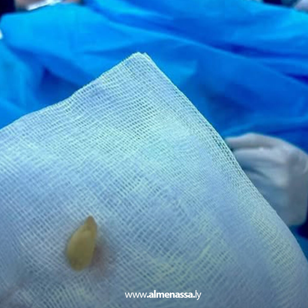 Extra 141.jpg1 141 اختناق رضيع ببذرة برتقال في مصراتة وتدخل طبي عاجل ينقذ حياته