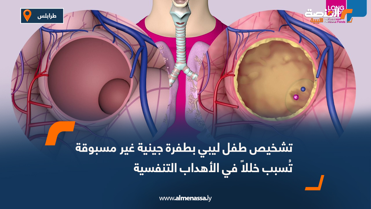 تشخيص طفل ليبي بطفرة جينية غير مسبوقة تُسبب خللاً في الأهداب التنفسية