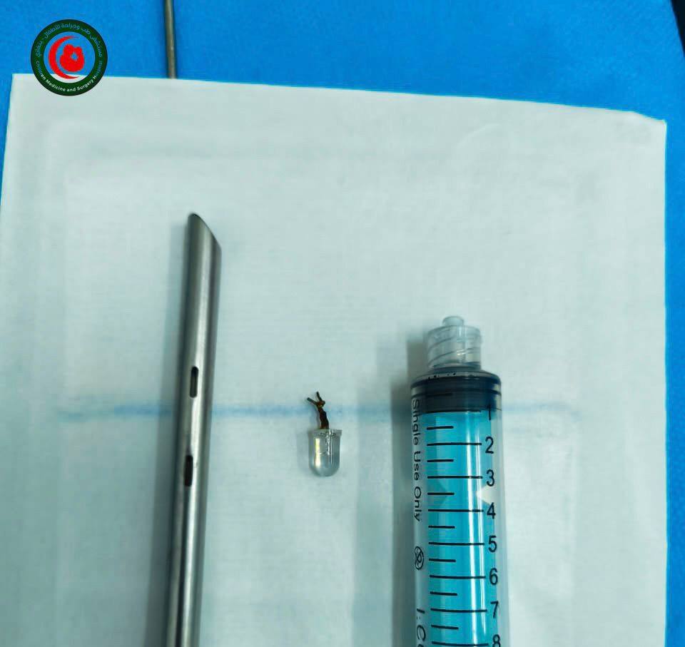 فريق طبي بمستشفى الأطفال بنغازي ينقذ رضيعا من خطر اختناق بعد استخراج جسم غريب من القصيبات الهوائية 1 3 1