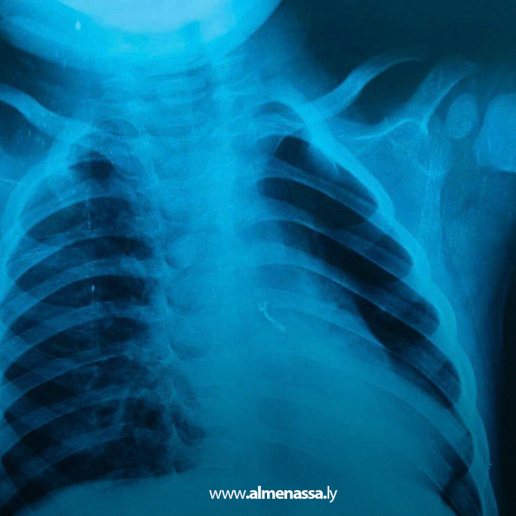 فريق طبي بمستشفى الأطفال بنغازي ينقذ رضيعا من خطر اختناق بعد استخراج جسم غريب من القصيبات الهوائية 2 extra Recovered 31