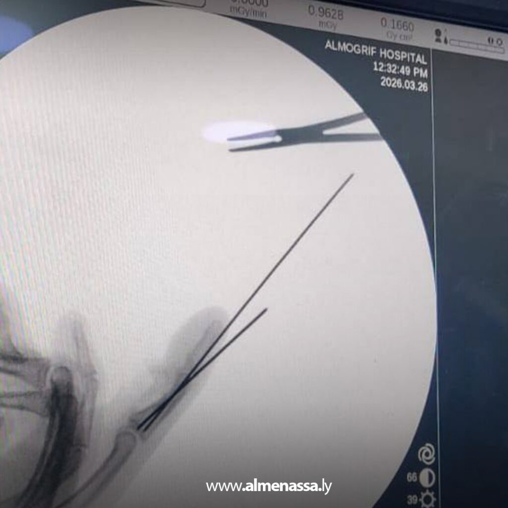 Extra 136 نجاح عملية جراحية دقيقة بمستشفى الشهيد أمحمد المقريف المركزي التعليمي بأجدابيا