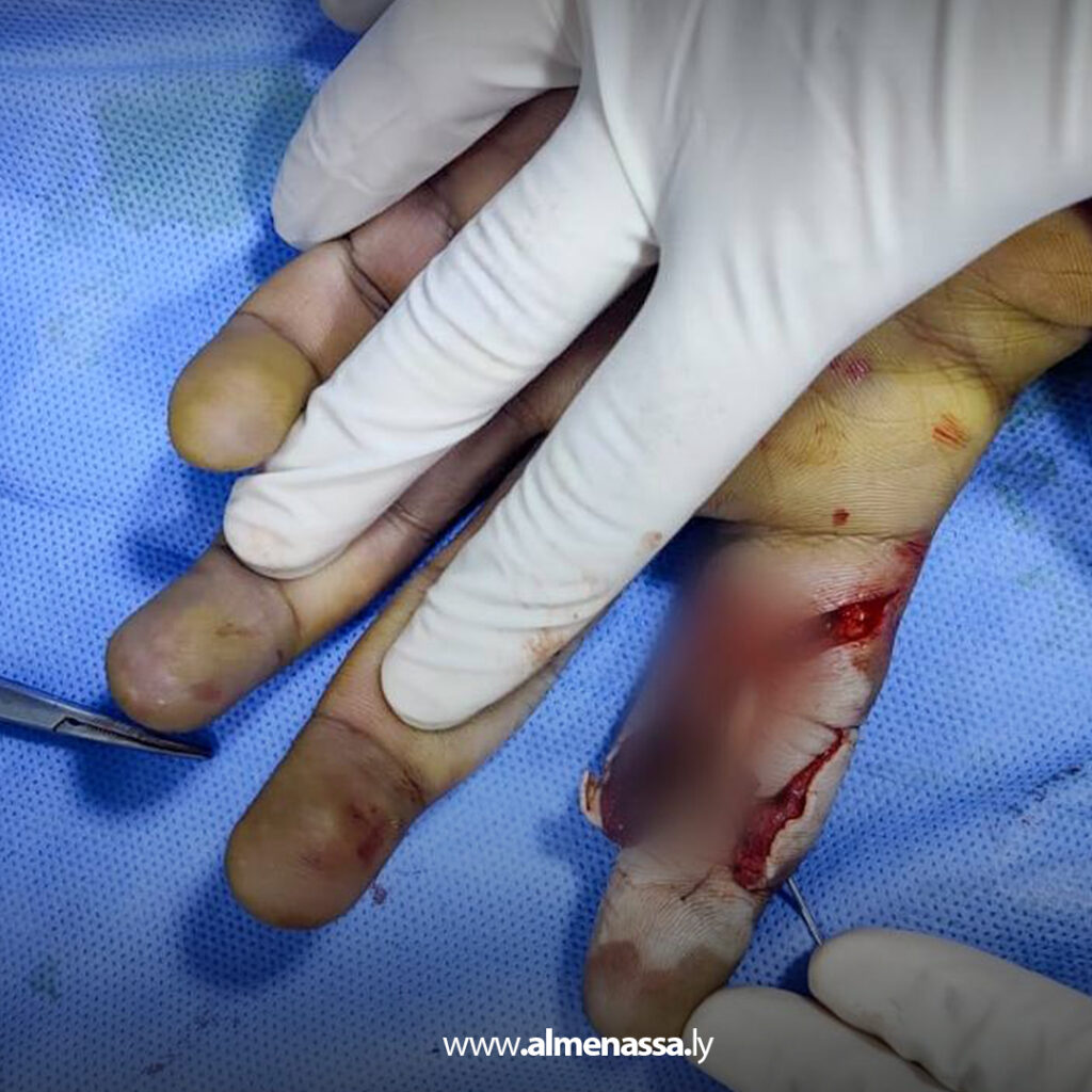 Extra 14.jpg2 14 نجاح عملية جراحية دقيقة بمستشفى الشهيد أمحمد المقريف المركزي التعليمي بأجدابيا