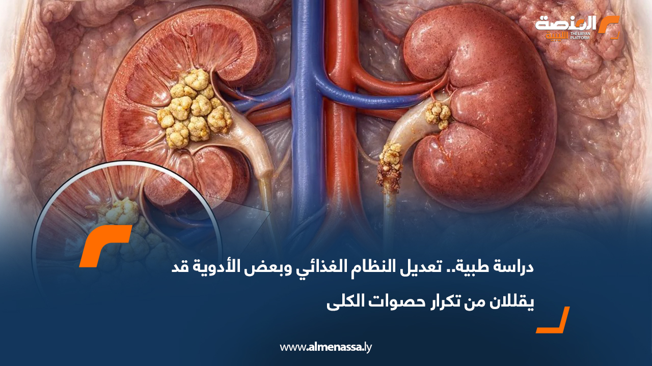 دراسة طبية.. تعديل النظام الغذائي وبعض الأدوية قد يقللان من تكرار حصوات الكلى