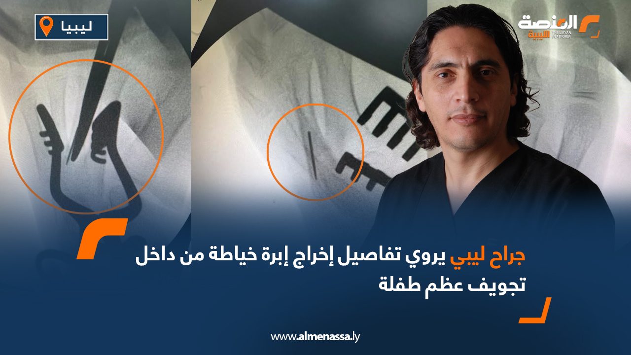 جراح ليبي يروي تفاصيل إخراج إبرة خياطة من داخل تجويف عظم طفلة