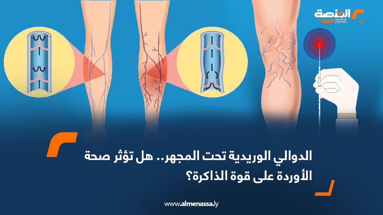 الدوالي الوريدية تحت المجهر.. هل تؤثر صحة الأوردة على قوة الذاكرة؟