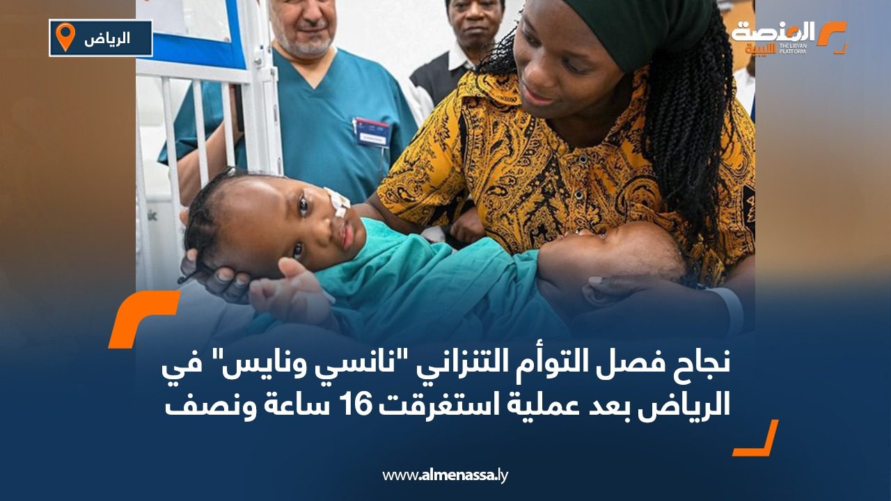 نجاح فصل التوأم التنزاني "نانسي ونايس" في الرياض بعد عملية استغرقت 16 ساعة ونصف