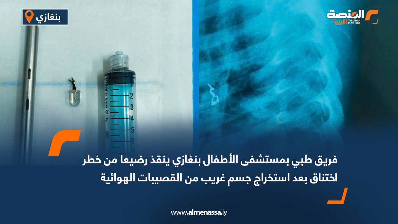 فريق طبي بمستشفى الأطفال بنغازي ينقذ رضيعا من خطر اختناق بعد استخراج جسم غريب من القصيبات الهوائية