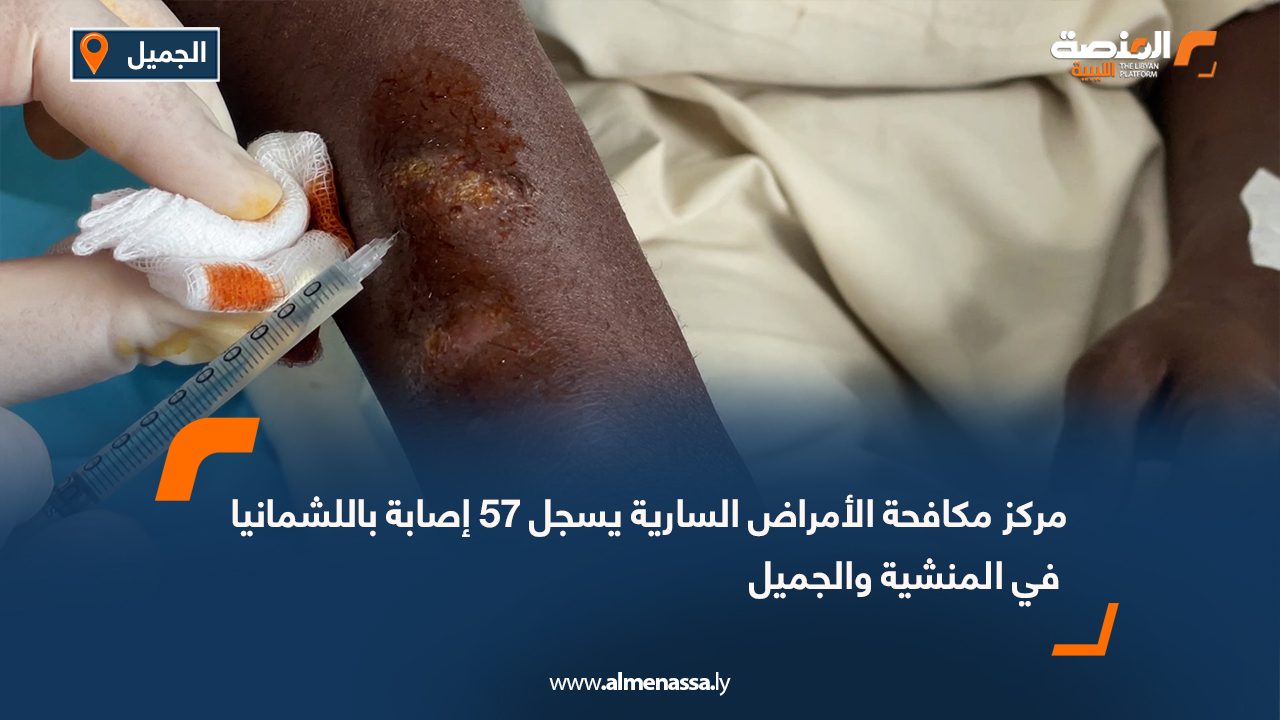 مركز مكافحة الأمراض السارية يسجل 57 إصابة باللشمانيا في المنشية والجميل
